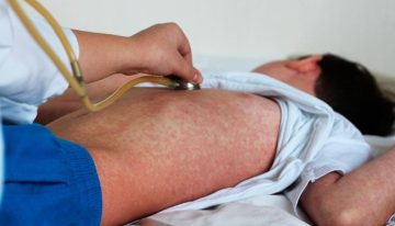 Canadá pierde su estatus de país libre de sarampión tras casi tres décadas