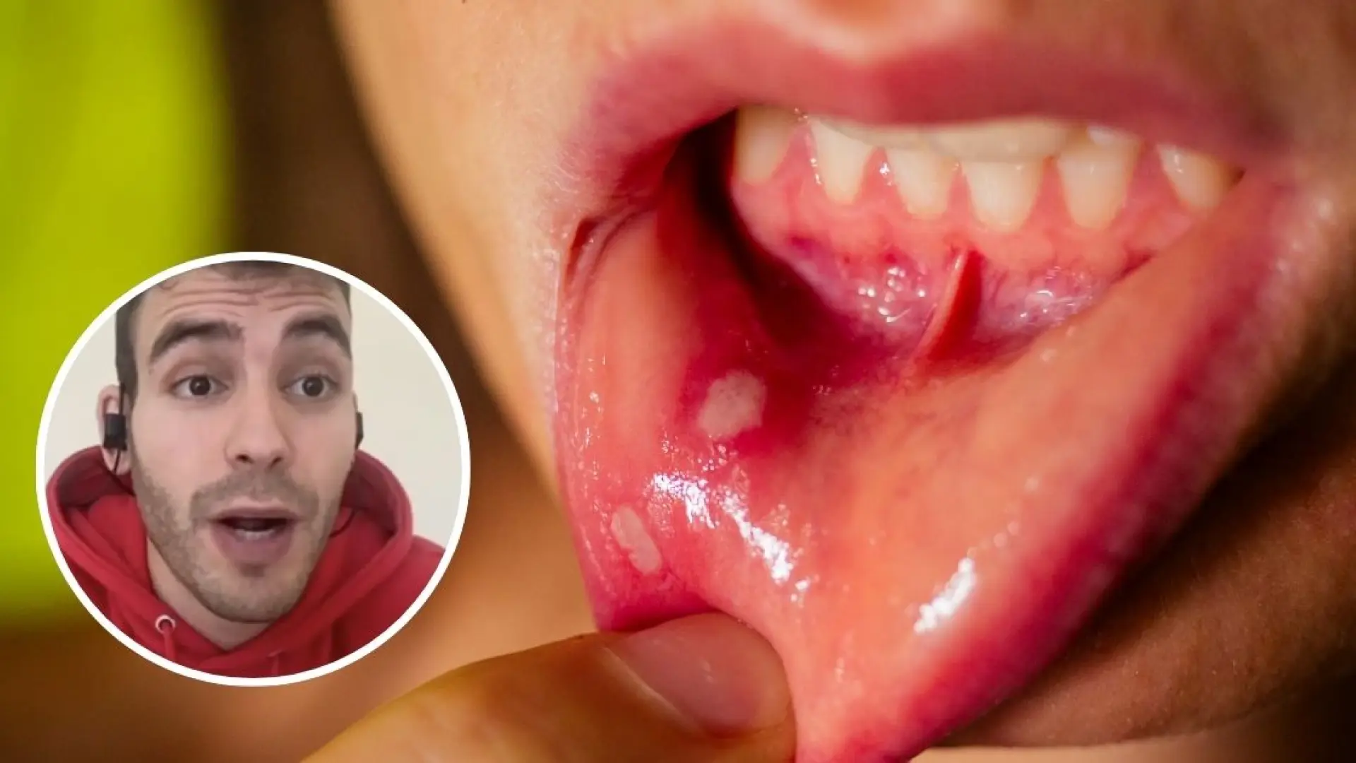 Jorge Ángel, enfermero: «Las aftas aparecen por estrés o un deterioro del sistema inmunitario”