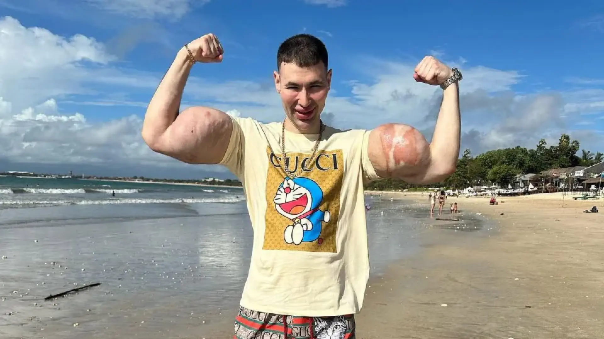 El 'Popeye ruso' podría sufrir la amputación de ambos brazos tras años de inyecciones descontroladas para aumentar sus bíceps