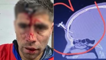 Le clavaron una llave en la cabeza a un futbolista del Ascenso durante una salvaje pelea en un torneo de fútbol femenino