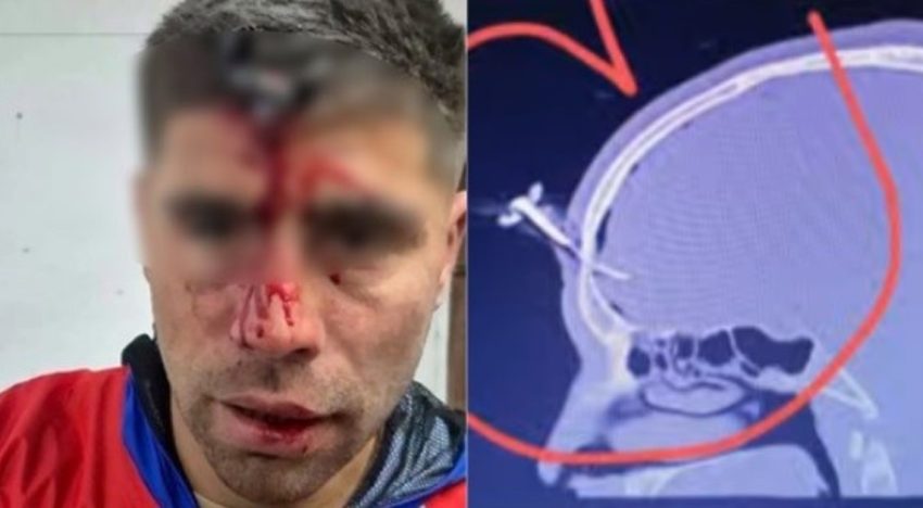 Le clavaron una llave en la cabeza a un futbolista del Ascenso durante una salvaje pelea en un torneo de fútbol femenino