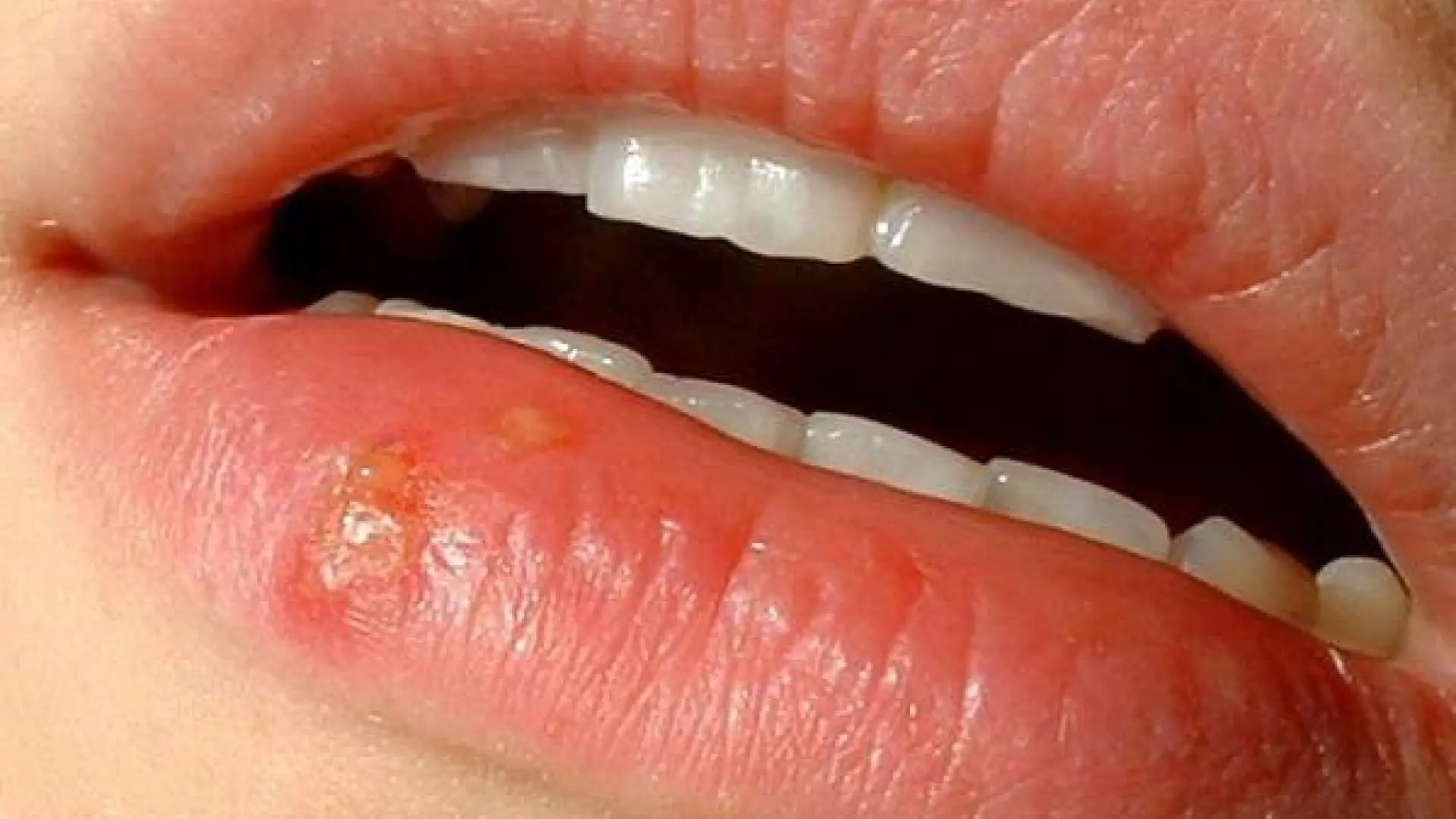 El herpes labial induce cambios neuronales similares a los del alzhéimer, según un nuevo estudio