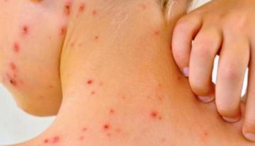 OPS emite alerta epidemiológica ante la persistencia de sarampión en las Américas