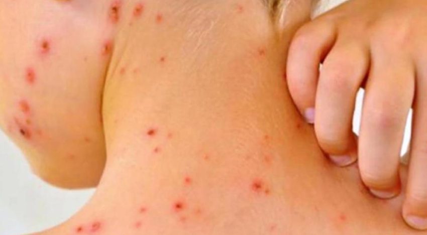 OPS emite alerta epidemiológica ante la persistencia de sarampión en las Américas