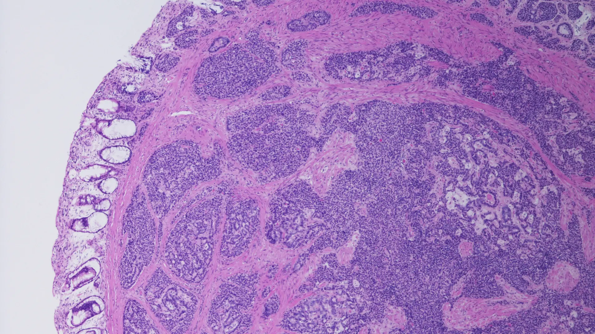 Detectan un 'código secreto' en la sangre que predice con precisión el cáncer colorrectal