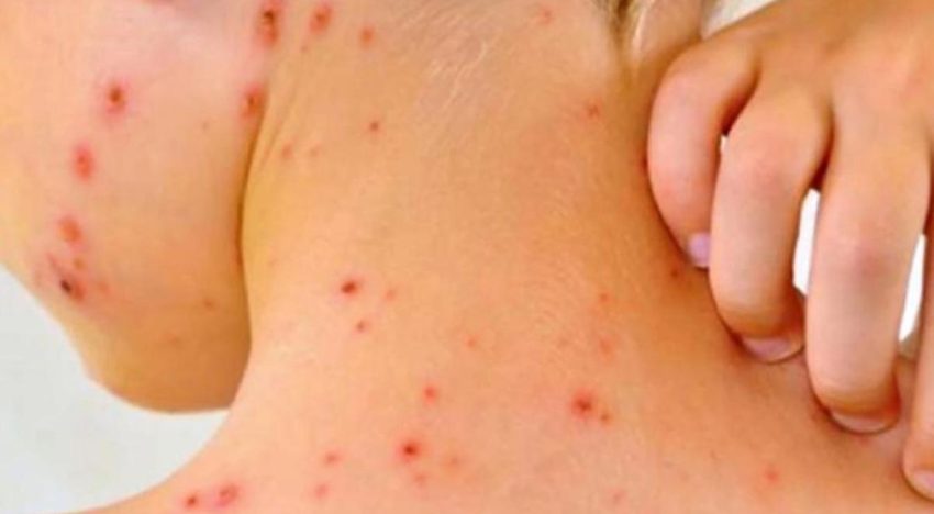 CDMX reporta primera muerte por sarampión