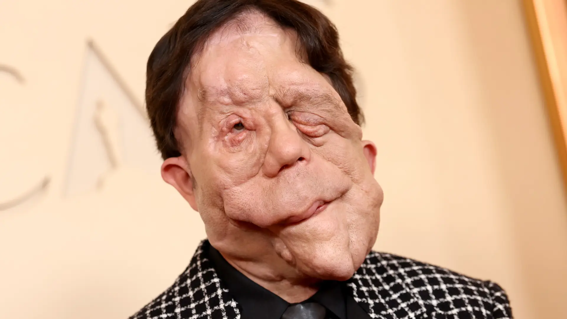 Así es la enfermedad que afecta al rostro de Adam Pearson: aparece en 1 de cada 2.500 personas