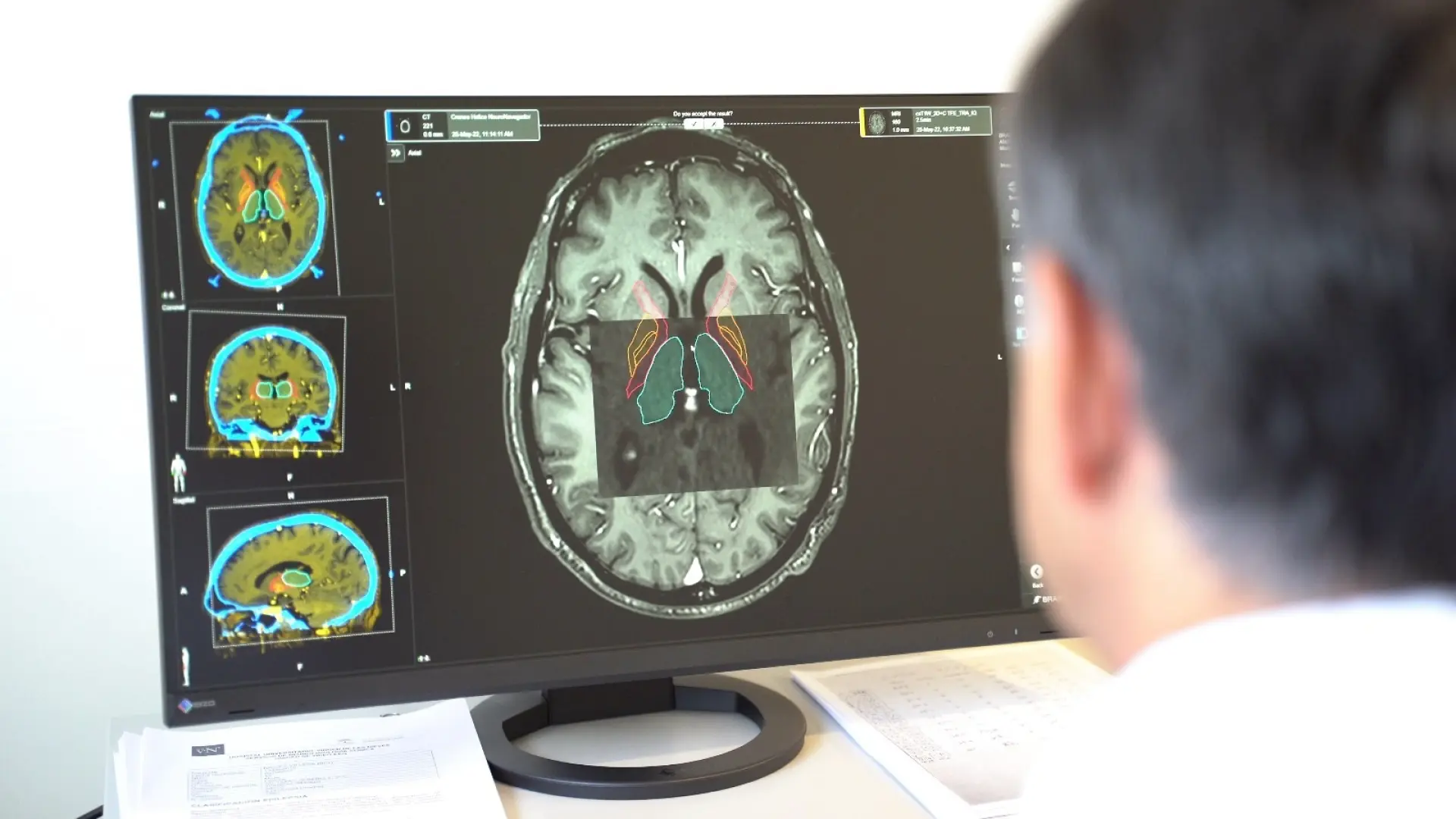 Por qué el párkinson se considera ya la «nueva pandemia»: «Hay un aumento global que va más allá del envejecimiento»