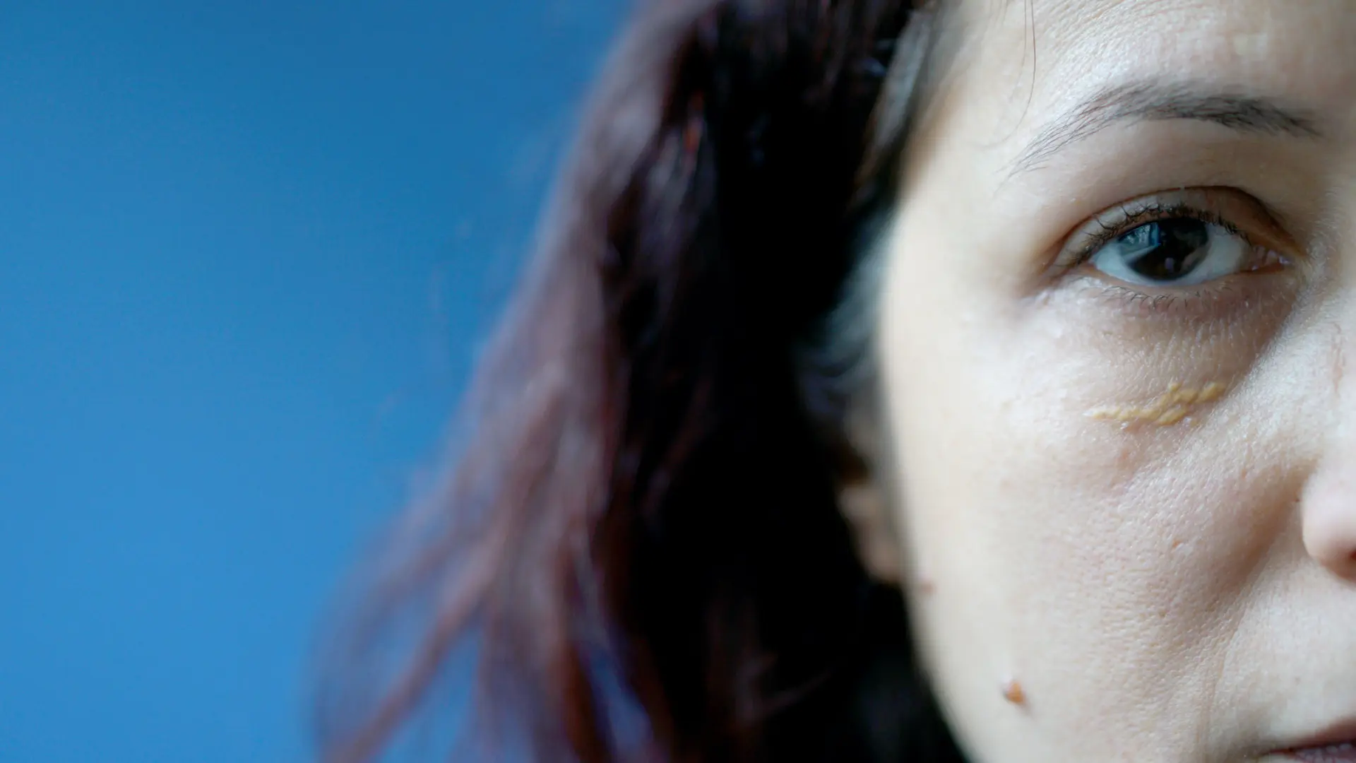 ¿Qué son los xantelasmas? La señal en los ojos que puede ser síntoma de colesterol alto