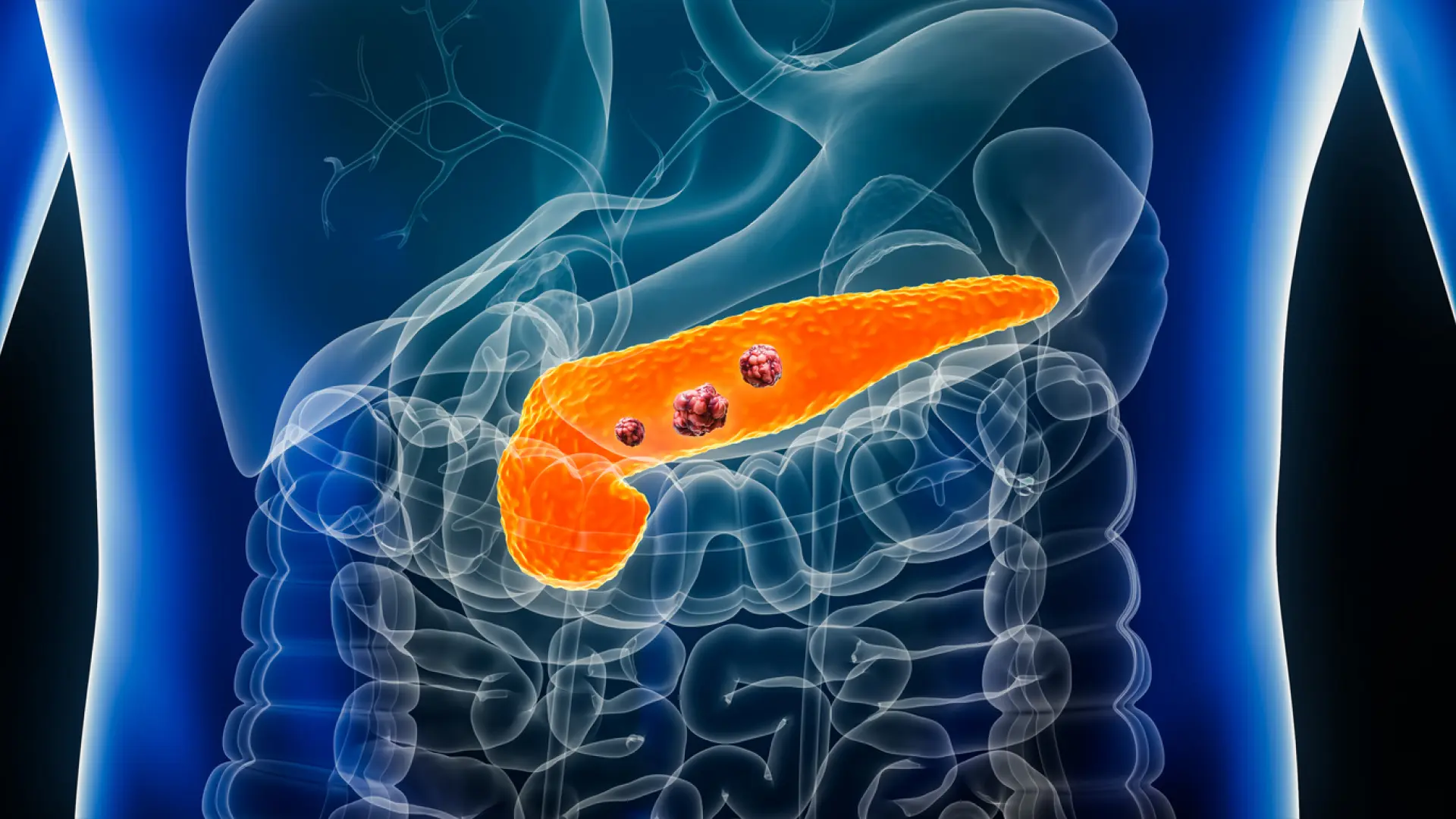 Un ensayo identifica un tratamiento que duplica la supervivencia de pacientes con cáncer de páncreas avanzado
