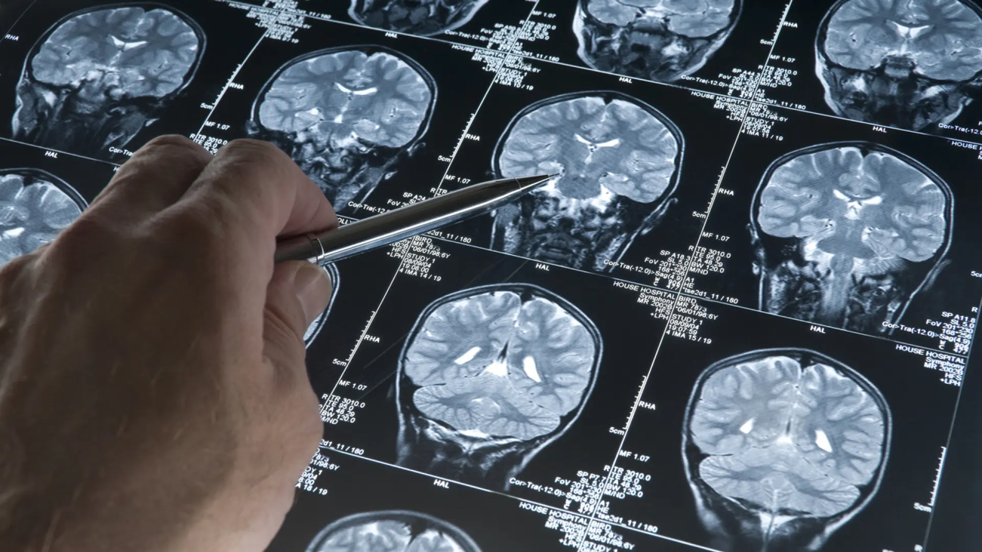 ¿Cómo se desequilibra el cerebro con el Alzheimer? Investigadores desarrollan un índice que analiza la atrofia y es clave para el avance de la enfermedad