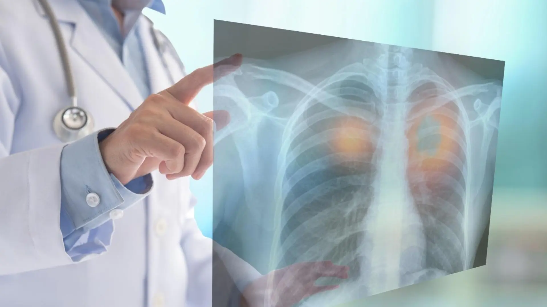 Científicos españoles logran una «marcada regresión» del cáncer de pulmón degradando la proteína KRAS