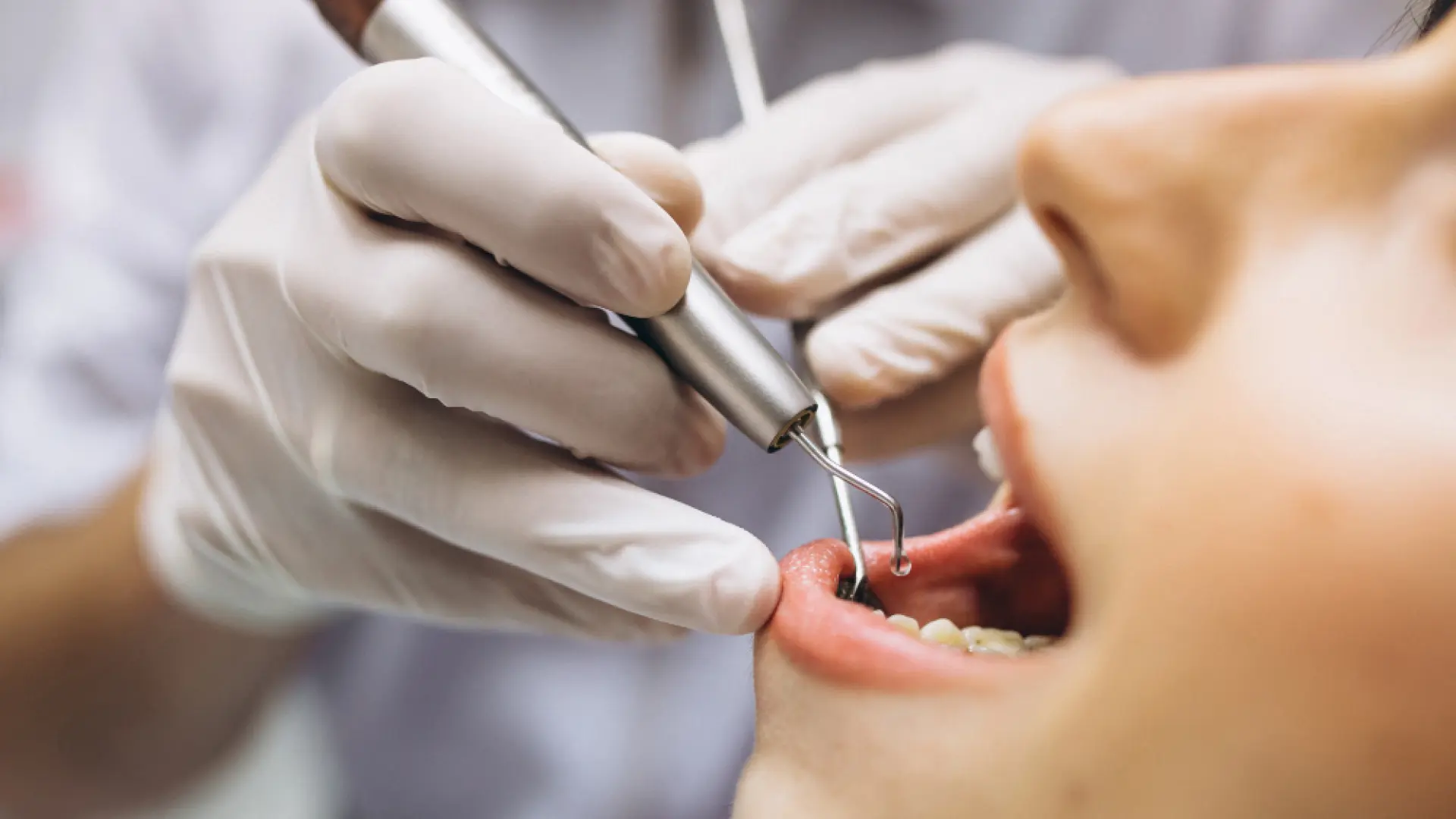 La microbiota dental: 700 bacterias viven en tu boca organizadas hasta que se rompe el equilibrio… y empiezan los problemas