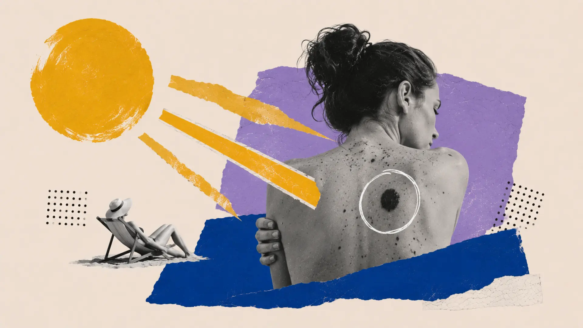 El sol le hace daño a tu piel: este es el riesgo de melanoma, el cáncer de piel más agresivo