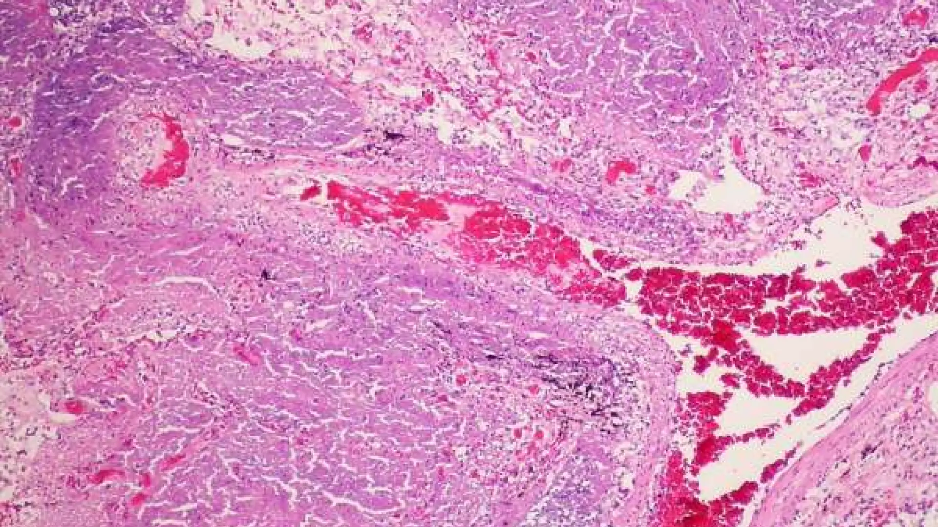 Las futuras vacunas contra la tuberculosis podrían salvar 7 millones de vidas