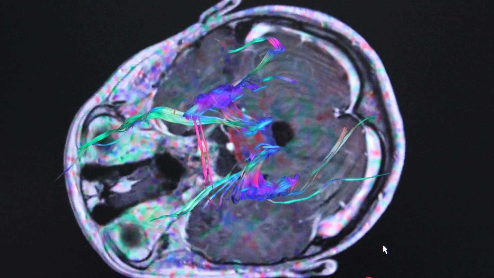 Desarrollan una innovadora prueba para detectar el cáncer cerebral que reduce el diagnóstico de semanas a horas