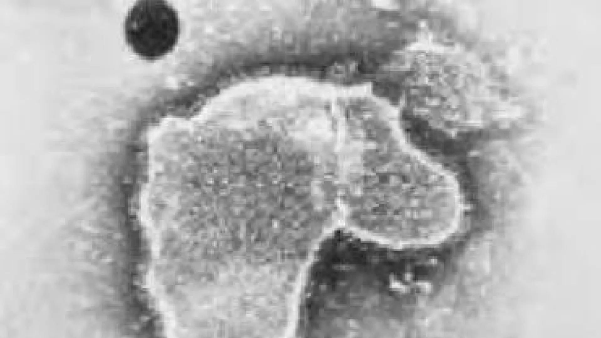 Identifican los tres primeros casos de bronquiolitis por una mutación del VRS que desafía al tratamiento que protege a los bebés