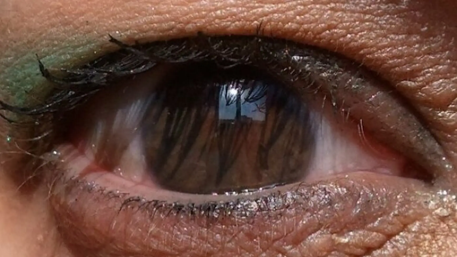 La ansiedad, la depresión y el estrés pueden asociarse a problemas de la superficie ocular