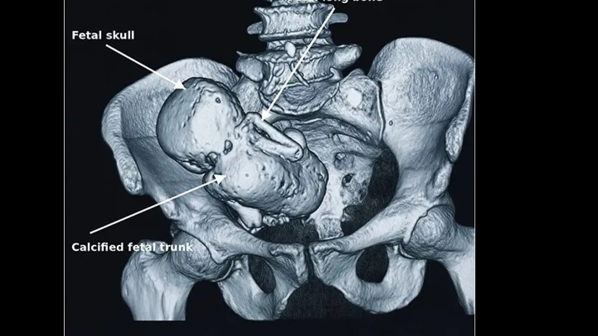 Una mujer acude al médico con un dolor de vientre que duraba tres años y hallan un bebé calcificado: solo hay 340 casos en la historia