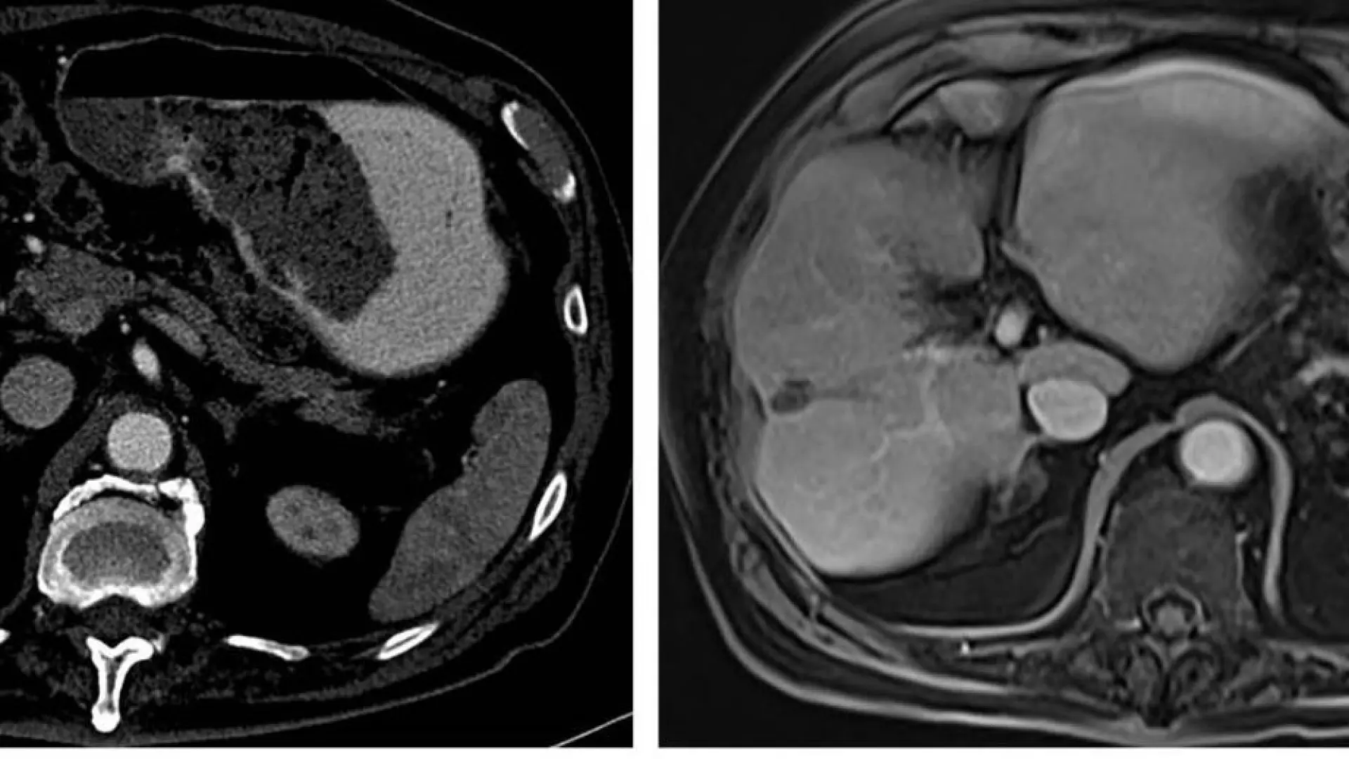 Un estudio muestra la eficacia de una combinación de dos inmunoterapias frente a cáncer de hígado de mal pronóstico